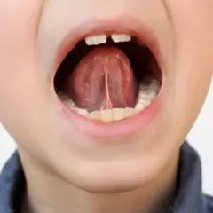 Boca abierta de un niño mostrando la lengua y el frenillo.