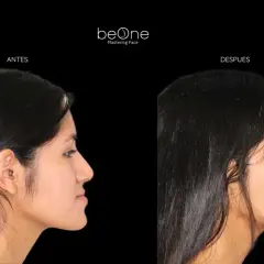 Perfil de mujer antes y después de una operación de mandíbula. La imagen muestra un cambio notable en la proyección facial.