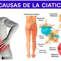 Ilustración muestra las causas de la ciática: hernia de disco, nervio ciático irritado y espasmo muscular, explicando los síntomas.