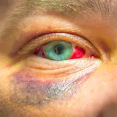 Ojo morado por golpe, con la esclerótica enrojecida. Buscando un remedio casero para aliviar la inflamación y el dolor.