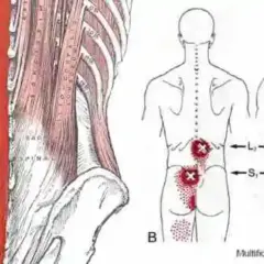 Anatomía de la espalda con flechas rojas señalando la zona afectada por un posible desgarro muscular espalda. Puntos rojos indican dolor.