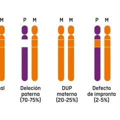 Representación de cromosomas 15q11-q13, mostrando variaciones genéticas asociadas al síndrome de Prader-Willi: normal, deleción paterna, duplicación materna, defecto de impronta y traslocaciones.