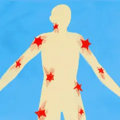 Silueta humana con puntos rojos que representan qué son los puntos gatillo, distribuidos en cuello, hombros, brazos y torso.