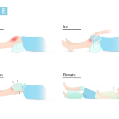 Ilustración del método RICE: reposo, hielo, compresión y elevación para tratar lesiones.
