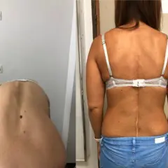 Comparación de la espalda de una mujer antes y después de la corrección de escoliosis. Se puede corregir la escoliosis en adultos.