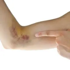 Brazo con hematoma, sangre coagulada bajo la piel como quitar.
