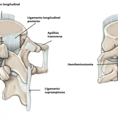 Ilustración de la anatomía lumbar antes y después de una hemilaminectomía, mostrando ligamentos y apófisis.