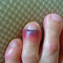 Un dedo del pie con un gran hematoma morado y rojo, indicando una lesión.