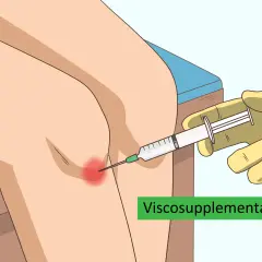 Inyección de líquido sinovial en la rodilla para aliviar el dolor.