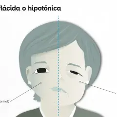 Ilustración comparativa de un rostro con parálisis facial. Un lado muestra un hemisferio sano, el otro un hemisferio con parálisis facial, con hipotonía.