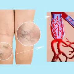 Piernas con várices y detalle de insuficiencia venosa, mostrando el flujo sanguíneo alterado en las venas.