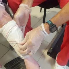 Manos enguantadas vendan pierna con úlceras por presión.