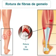Ilustración médica de una rotura de fibras del gemelo, mostrando zonas de dolor y la anatomía muscular de la pantorrilla.