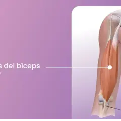 Ilustración de tendinitis del bíceps, mostrando el músculo y el tendón del bíceps.