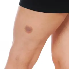 Pierna con moretones por golpes, evidencia de un impacto.