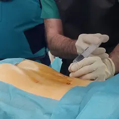 Procedimiento médico de ozonoterapia para tratar una hernia discal. Un profesional sanitario administra una inyección en la zona lumbar.