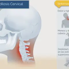 Ilustración de la columna cervical con zonas de dolor, junto a iconos de síntomas.
