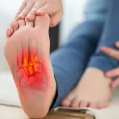Pie con dolor e inflamación en la planta, indicando fascitis plantar.