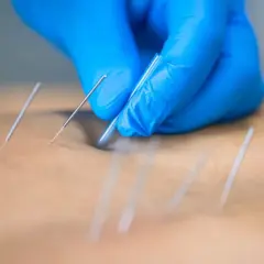 Manos enguantadas aplican agujas para punción seca, aliviando una contractura muscular.