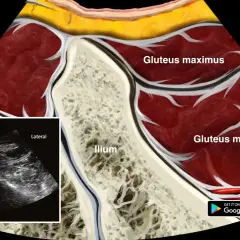 Anatomía de la pelvis y glúteos, mostrando el ilion, glúteo mayor y medio. Ecografía de la zona del PSIS y sacro, útil para diagnosticar el síndrome piriforme.