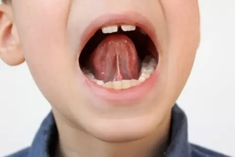 Boca abierta de un niño mostrando la lengua y el frenillo.