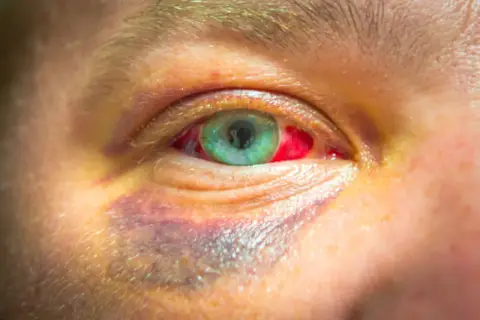 Ojo morado por golpe, con la esclerótica enrojecida. Buscando un remedio casero para aliviar la inflamación y el dolor.