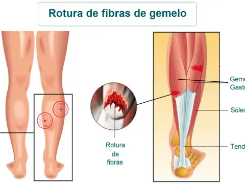 Fibras del gemelo: ¿Por qué no es solo un músculo?