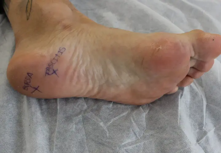 Marcado en el pie, "BURSA" y "FASCITIS" indican áreas de dolor, sugiriendo bursitis y fascitis plantar.
