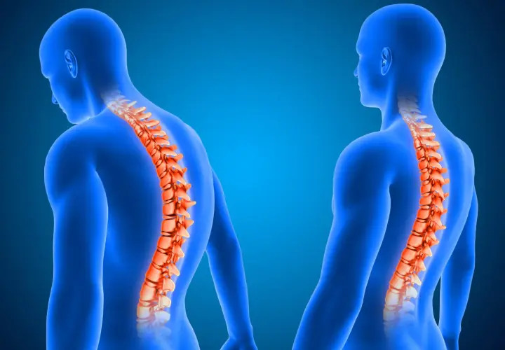 Dos figuras humanas azules muestran la columna vertebral en naranja.