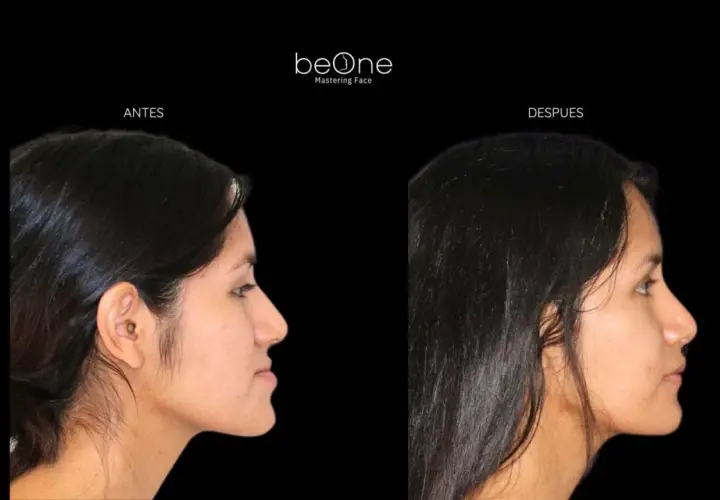 Perfil de mujer antes y después de una operación de mandíbula. La imagen muestra un cambio notable en la proyección facial.