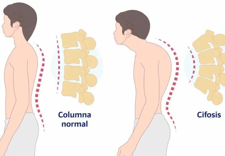 Comparación de columna normal y cifosis dorsal. La imagen muestra la curvatura de la espalda y la columna vertebral en dos posturas.