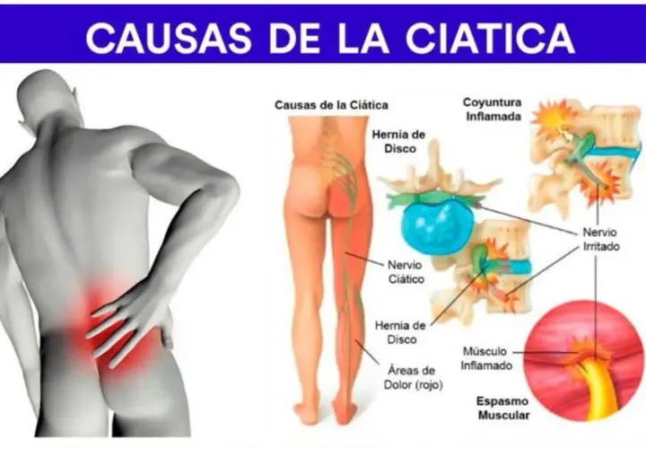 Ilustración muestra las causas de la ciática: hernia de disco, nervio ciático irritado y espasmo muscular, explicando los síntomas.