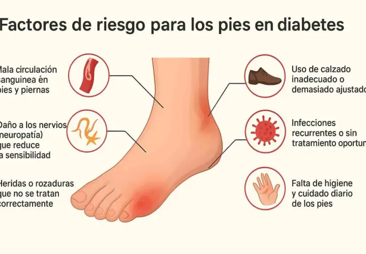 Factores de riesgo para pies diabéticos: mala circulación, neuropatía, heridas, calzado inadecuado, infecciones y falta de higiene.