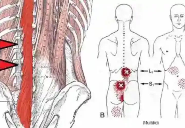 Anatomía de la espalda con flechas rojas señalando la zona afectada por un posible desgarro muscular espalda. Puntos rojos indican dolor.