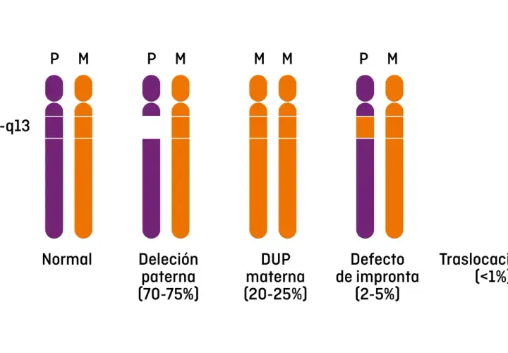 Representación de cromosomas 15q11-q13, mostrando variaciones genéticas asociadas al síndrome de Prader-Willi: normal, deleción paterna, duplicación materna, defecto de impronta y traslocaciones.