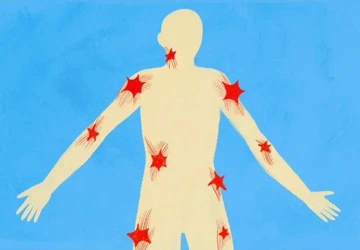 Silueta humana con puntos rojos que representan qué son los puntos gatillo, distribuidos en cuello, hombros, brazos y torso.