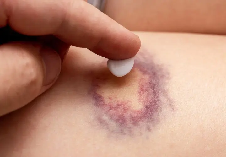 Dedo aplica crema sobre un moretón morado. Descubre cómo quitar moretones en minutos con este método.