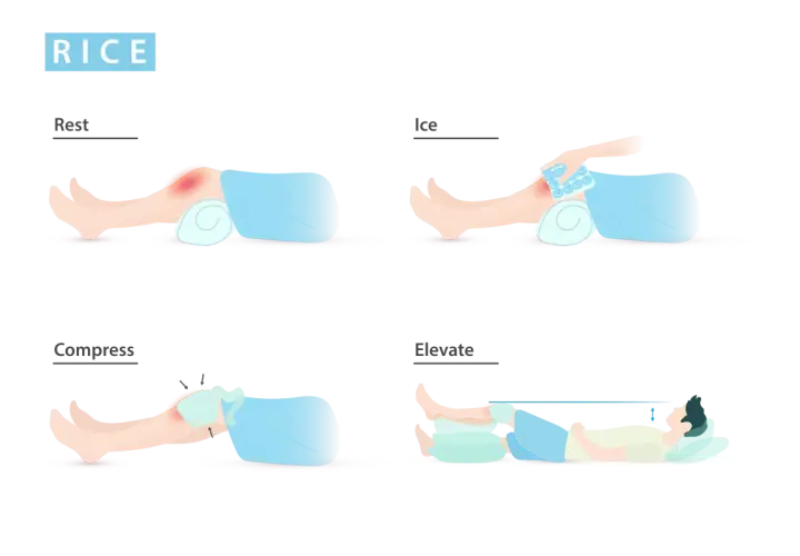 Ilustración del método RICE: reposo, hielo, compresión y elevación para tratar lesiones.
