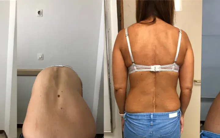Comparación de la espalda de una mujer antes y después de la corrección de escoliosis. Se puede corregir la escoliosis en adultos.