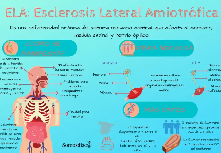 Infografía sobre la ELA, mostrando sus primeros síntomas como pérdida de control del movimiento, calambres y dificultad para respirar.
