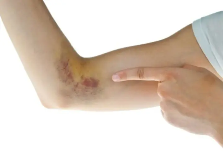 Brazo con hematoma, sangre coagulada bajo la piel como quitar.