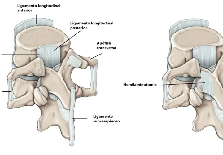 Ilustración de la anatomía lumbar antes y después de una hemilaminectomía, mostrando ligamentos y apófisis.