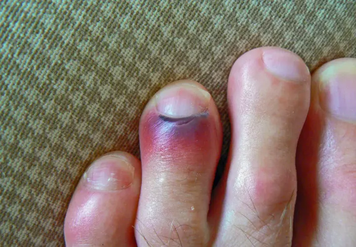 Un dedo del pie con un gran hematoma morado y rojo, indicando una lesión.