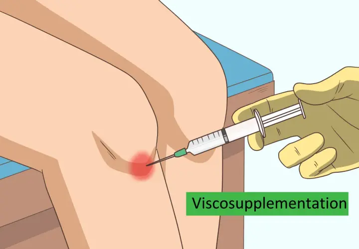 Inyección de líquido sinovial en la rodilla para aliviar el dolor.