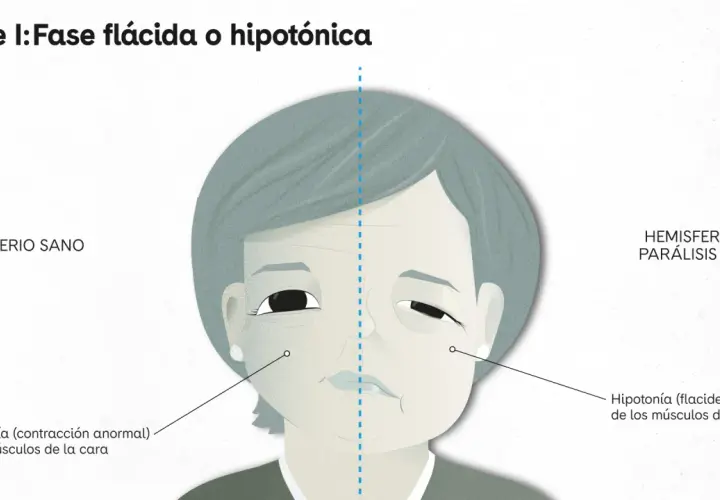 Ilustración comparativa de un rostro con parálisis facial. Un lado muestra un hemisferio sano, el otro un hemisferio con parálisis facial, con hipotonía.