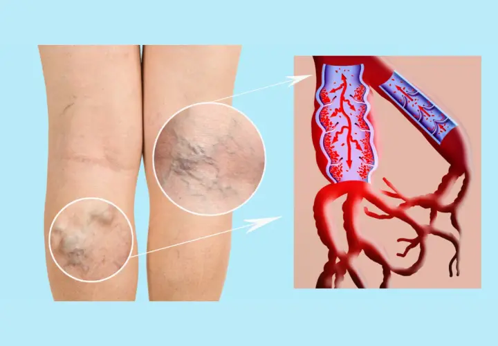 Piernas con várices y detalle de insuficiencia venosa, mostrando el flujo sanguíneo alterado en las venas.
