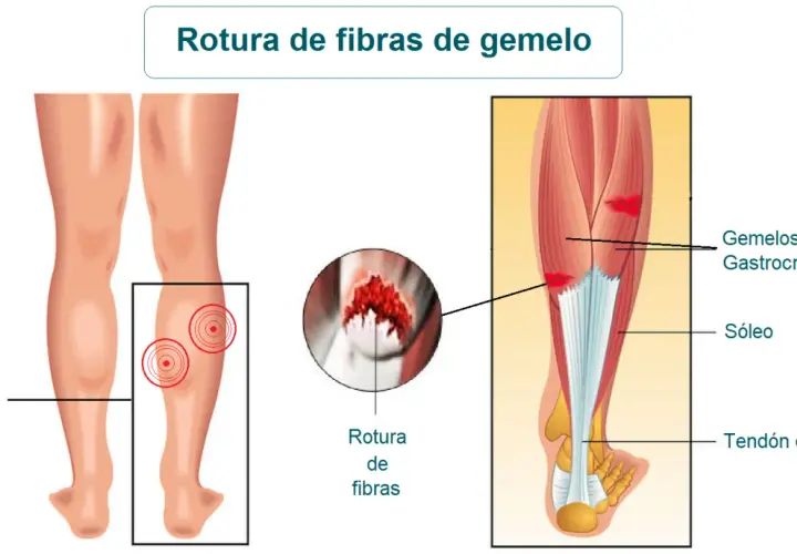 Ilustración médica de una rotura de fibras del gemelo, mostrando zonas de dolor y la anatomía muscular de la pantorrilla.