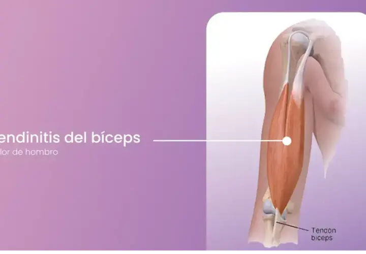 Ilustración de tendinitis del bíceps, mostrando el músculo y el tendón del bíceps.
