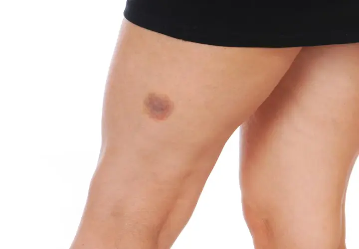 Pierna con moretones por golpes, evidencia de un impacto.