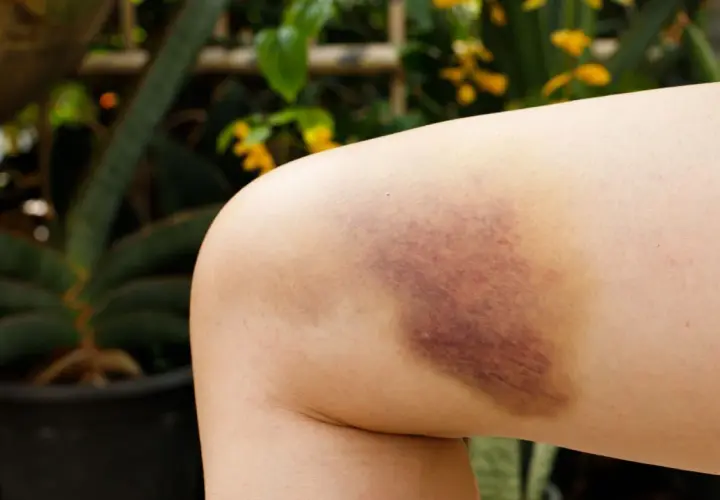 Pierna con un gran hematoma oseo, morado y amarillento, resultado de un golpe.
